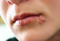 Cara Menghilangkan Bekas Luka Herpes