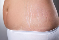 Cara Menyamarkan Stretch Mark