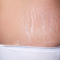 Cara Menyamarkan Stretch Mark