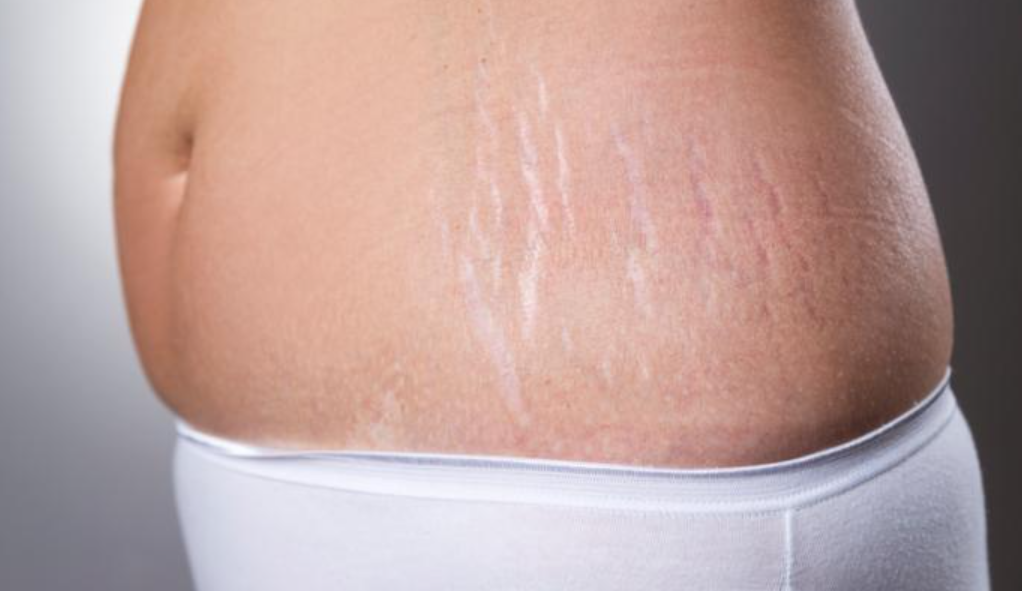 Cara Menyamarkan Stretch Mark